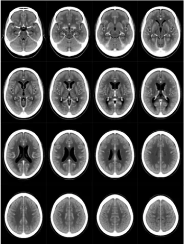 Figure 2.  A CT template set for the topographic mapping. The original stroke-control CT template 11 , with the 