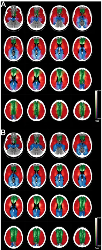Figure 3.  Infarct frequency maps with (A) or without (B) interterritorial overlaps displayed as color blends