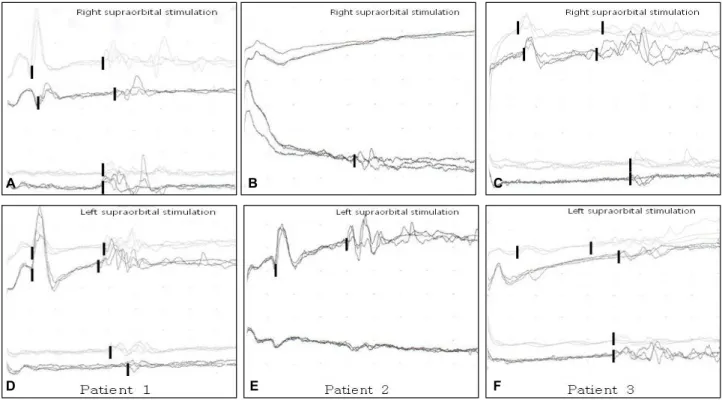 Figure 1. Blink reflex in patients with delayed facial palsy. (A, B) Patient 1. Initial blink reflex (light line) reveals  normal