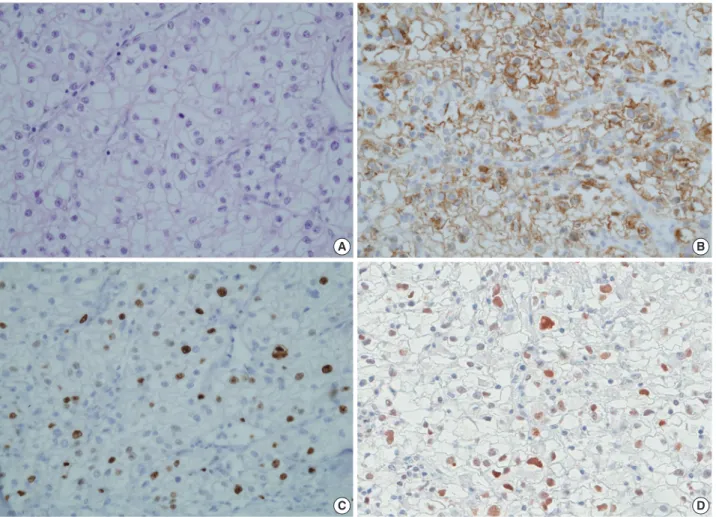 Fig. 1. Insulin-like growth factor II mRNA-binding protein 3 (IMP3), Ki-67, and p53 expression levels in a clear cell renal cell carcinoma (CC- (CC-RCC) patient with metastasis