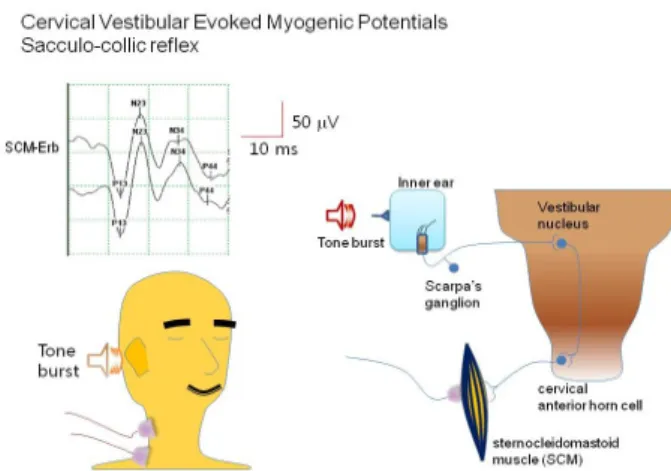Figure 8. Cervical vestibular evoked myogenic potentials  (cVEMP). Schematic drawings show cVEMP pathway and  location of electrodes