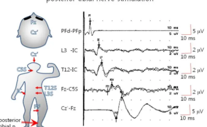 Figure 3. Location of stimulation, placement of recording  electrodes and somatosensory evoked potentials by right  posterior tibial nerve stimulation