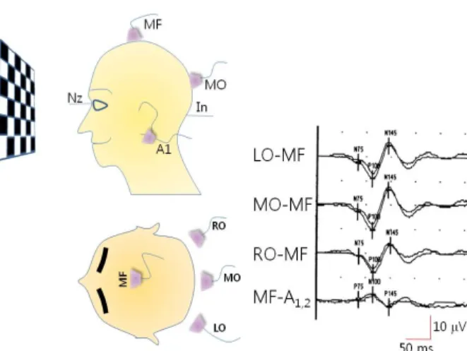Figure 4. Pattern reversal visual evoked potentials on Queen  Square montage. The data show P100 waves on LO, RO, and MO recordings