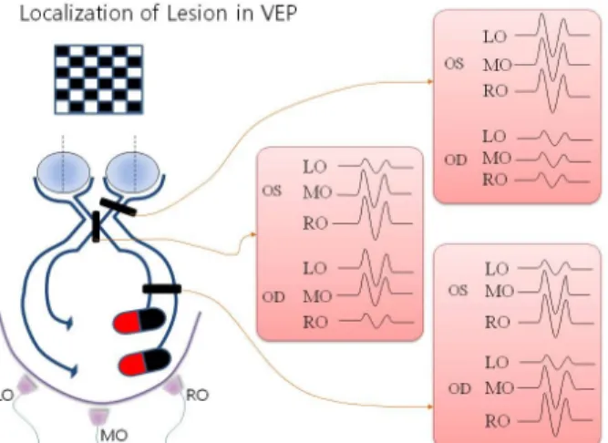 Figure 6. Paradoxical lateralization of P100 on occipital  recordings. The schematic drawings show paradoxical  later-alization on large hemifield stimulation (A), but not on small hemifield stimulation (B) because of the directions of  occi-pital dipoles.