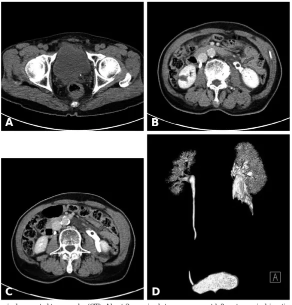Fig. 1. Abdominal computed tomography (CT). About 3 mm sized stone was seen at left ureterovesical junction on precon- precon-trast CT image (A)