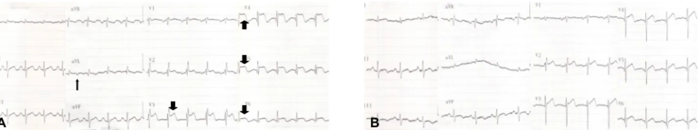 Figure 2. A coronary angiogram performed at 11th week after admission. Right coronary artery (thin filled arrow), left main  coronary artery (thick filled arrow), left anterior descending branch (thin empty arrow) and left circumflex branch (thick  empty a