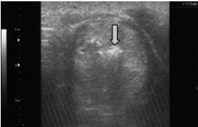 Fig. 3. The untreated remaining sol- sol-id component shows internal  vascu-larity (arrow)