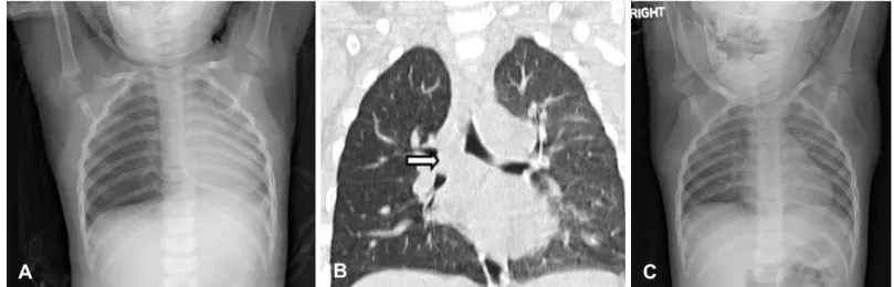 Fig. 1. Chest X-ray image shows a hyperinflation of the right lung (A). Chest CT shows a foreign body (arrow) in right main bronchus (B)
