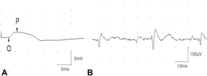 Figure 1. (A) Nerve conduction studies show low amplitude compound motor action potentials in the right accessory  nerve