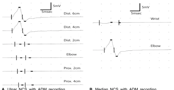 Figure 1. Findings of nerve conduction study in this patient. (A) Inching study of ulnar nerve along  the elbow with recording of the ADM