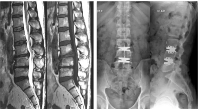 Figure 5. Forty-seven-year old male worker with chronic  low back pain (left). Satisfactory clinical and radiological  result at 2 years after L3-4-5 total disc replacement surgery  (right)