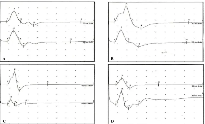 Figure 1. Compound muscle action potentials were recorded in bipolar (upper trace) and monopolar (lower trace) montage in median (A), ulnar (B), tibial (C) and peroneal nerves (D)