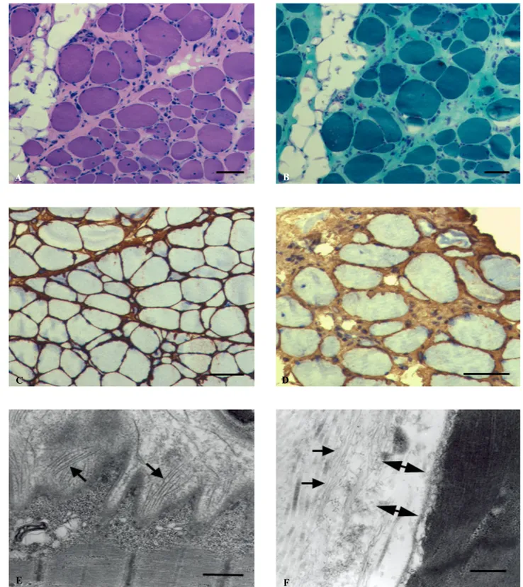 Figure 2. Histopathological and immunohistochemical findings of skeletal muscle. (A) H&amp;E stain shows fiber size variation  and few degenerating fibers