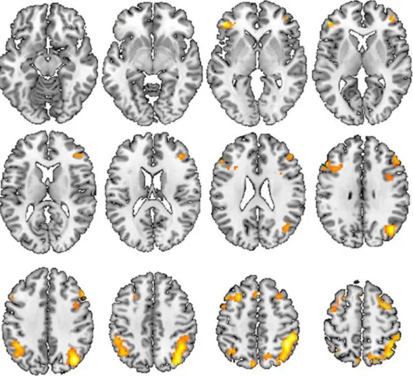 Figure 3. Between group analysis of 2-back task. The brain areas, which activated in control subjects compared to the lead-exposed subjects from between group analysis of 2-back task