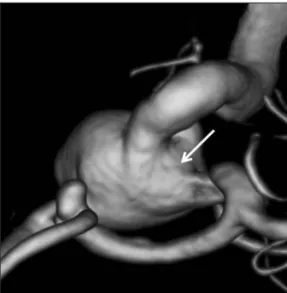 Fig. 1. Three-dimensional angiography showing an aneurysm at the an- an-terior communicating artery and a large aneurysm with a wide  circum-ferential neck (arrow) at the paraclinoid internal carotid artery