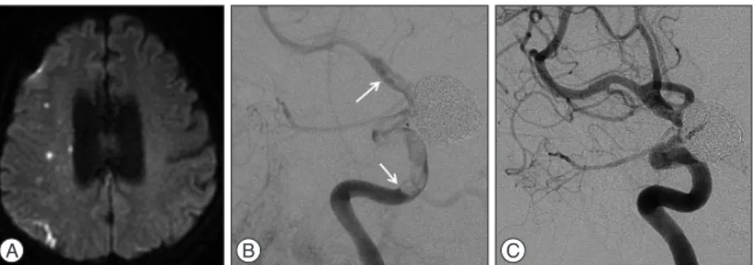 Fig. 3. A : Diffusion weighted image taken for evaluating the patient’s ischemic symptoms demon- demon-strating multiple embolic infarctions in the right hemisphere