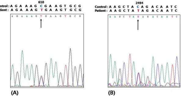 Figure 3. cDNA sequencing analysis of DYSF gene identified heterozygous mutations consisting of (A)  a nonsense mutation (C.610C>T;Arg204X) and (B) a nonsense mutation (c.2494C>T;Gln832X).