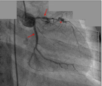 Fig. 4. A follow up coronary angiography showed patent left ante- ante-rior descending artery and aneurysmal change around the  pre-vious ballooning site (arrow head)