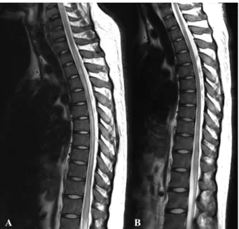 Figure 1. (A) Sagittal T2 weighted magnetic resonance  (MR) image of the spinal cord before treatment