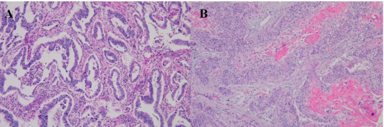 Fig.  1.  Comparison  of  Adenocarcinoma  (A)  and  squamous  cell  carcinoma  (B)  by  H&amp;E  staining