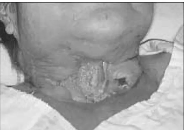 Fig. 3.  Clinical feature of neck area after 7 days of adm- adm-ission.         