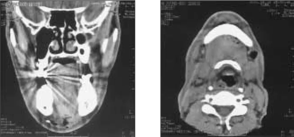 Fig. 15.  The  wound  is  healing  with  granulation  tissues (19th day of admission).