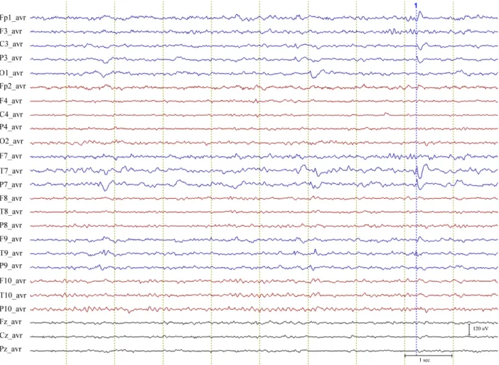 Figure 1. A segment of EEG obtained from an enrolled patient. A sharp wave (1) is seen on the temporal area of the  left cerebral hemisphere and the continuous background slow activities are also seen on the same hemisphere during  the EEG segment