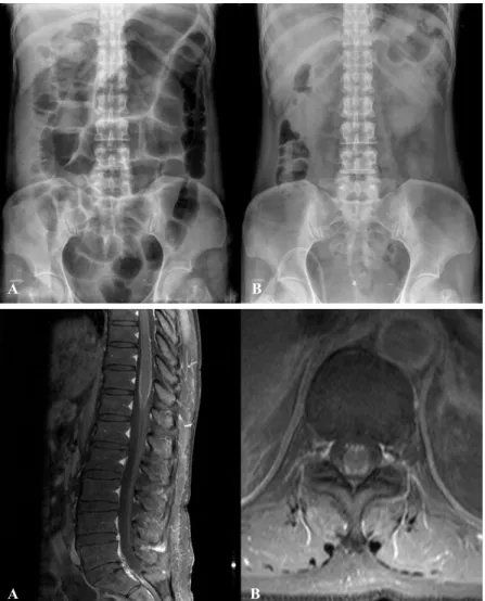 Figure 1. Simple abdomen x-rays show  diffuse distended small and large bowel  gas without evidence of obstruction on  admission (A)