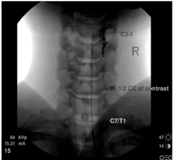 Figure 1. Interlaminar epidural steroid injection via  catheter. To decrease a risk of dural puncture, the  epi-dural space is accessed via the C7-T1 space and the  epidural catheter is fed through the introducer needle up  to the C3-4 level.1