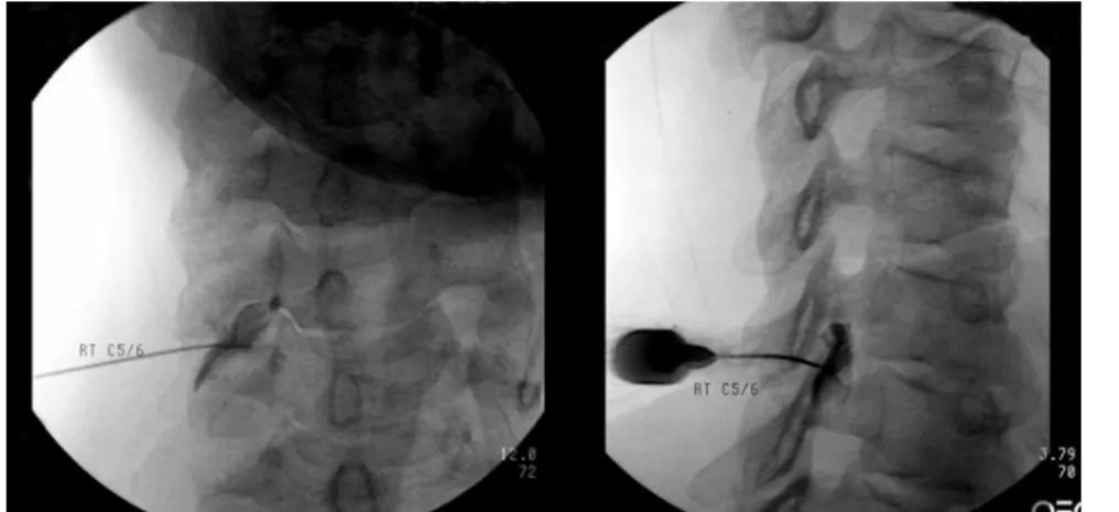 Figure 2. Transforaminal epidural  injection at the C5-6 level. AP  and lateral view: The pre-injected  contrast outlines a single spinal  nerve