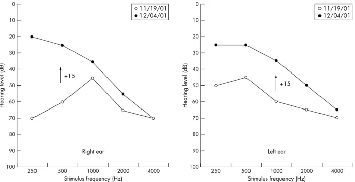 Figure 1 Pure-tone air conduction audiograms obtained on two different dates, 15 days apart (+15)