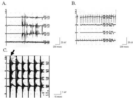 Figure 1. EMG monitoring. (A) Free-  running EMG shows phasic activities in  trace 1, 2, and 3