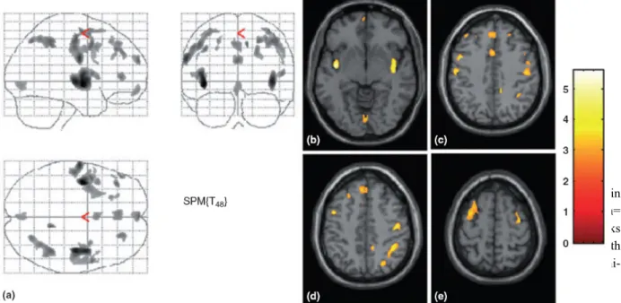 Figure 3. Activation of the ipsilateral pons in  patients with right-sided attacks (n= 