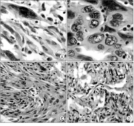 Fig. 2. Microscopic findings of  pleomorphic carcinoma reveal  var-ious histologic components  includ-ing spindle cells and giant cells  in the tumor areas