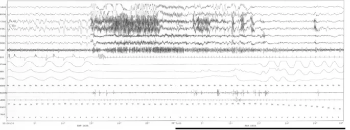 Figure 1. Electroencephalography (EEG) -polysomnography during paroxysmal attack. EEG shows generalized  slowing suggesting sleep stage 3 and numerous muscle artifacts