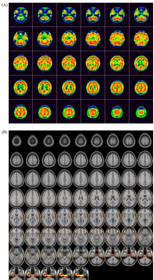 Figure 2. Subtraction of ictal-  interictal SPECT coregistered  with MRI (SISCOM) image