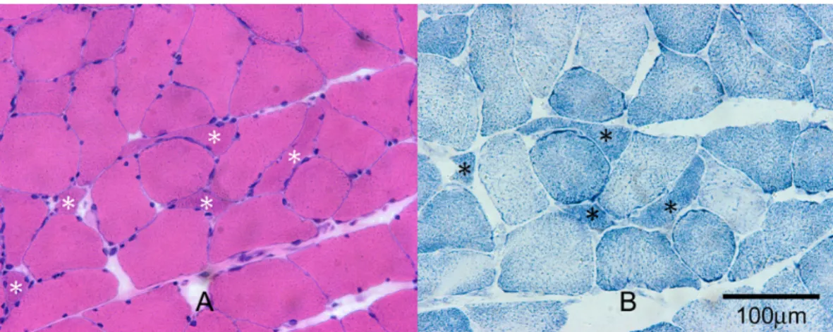 Figure 2. Muscle biopsy findings of the patient. Scattered angular atrophic fibers are seen (asterisk)