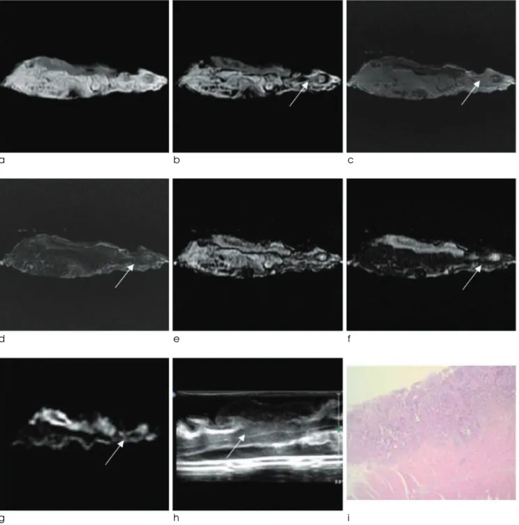 Fig. 2. Rectal cancer (T2, ulcerative type).
