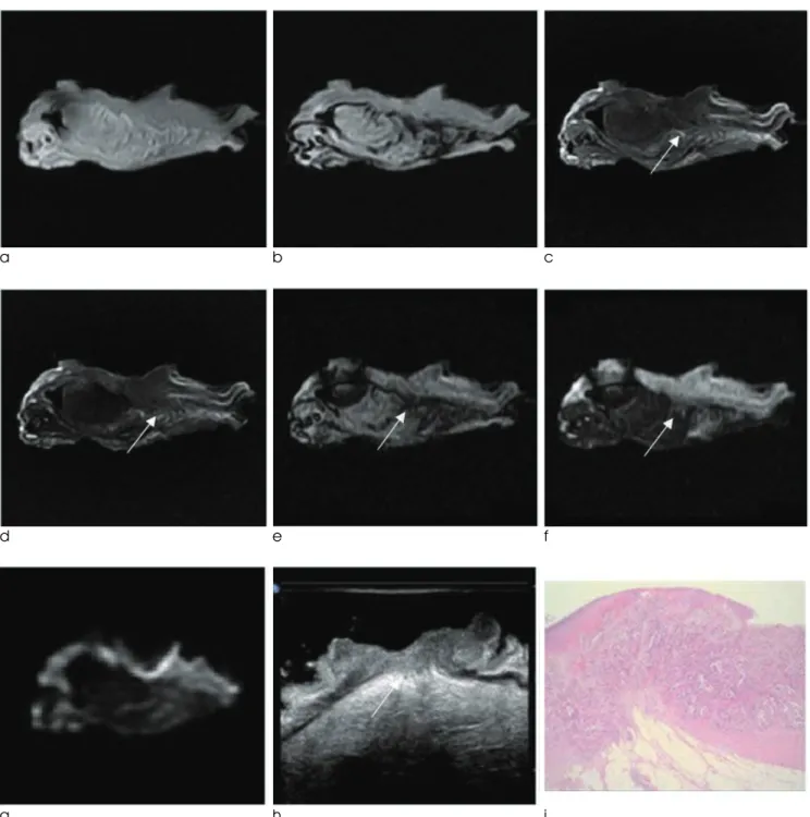 Fig. 3. Sigmoid colon cancer (T3, ulcerofungating type).