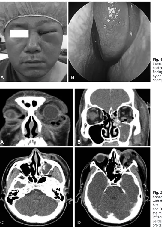 Fig. 2. Facial CT with contrast en-