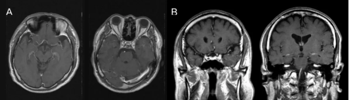 Figure 1. Initial brain MRI of the patient. Initial axial (A) and coronal (B) T1 enhanced images show  no remarkable abnormal findings in orbit, cavernous sinus, and brainstem