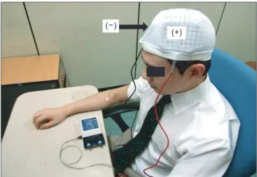Fig. 2. Anodal tDCS. The anode was positioned over the  M1 or DLPFC and the cathode over the contralateral  su-praorbital region (2 mA for 20 minutes on 5 consecutive  days)