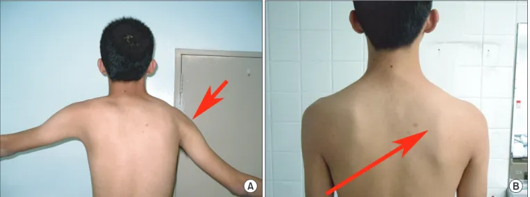 Fig. 1. Weakness of the shoulder abduction (A) and winging of the right scapula (B).