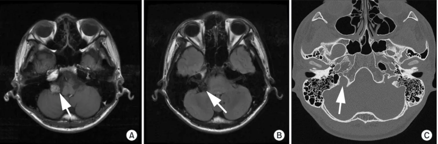 Fig. 3. Magnetic resonance imaging of the tumor located on the jugular foramen. (A) On T1-weighted image, the tu- tu-mor (arrow) shows high signal intensity when compared with brain matter