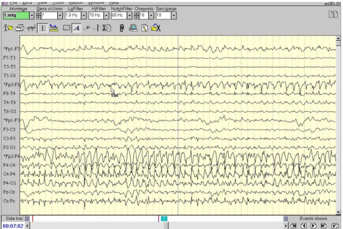 Figure 1. A case of non-convulsive status epilepticus which shows an ictal onset from right central area