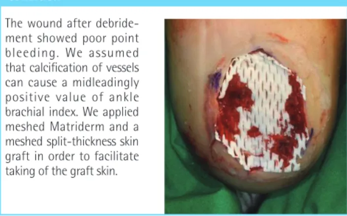 Fig. 5. Meshed Matriderm appliance with poor vascular  condition