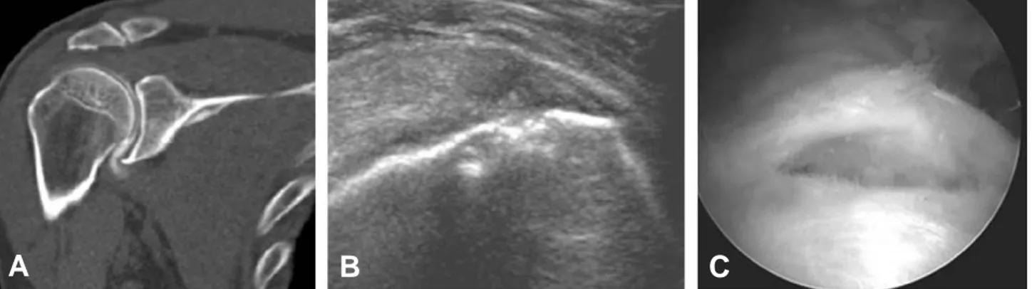 Fig. 1. (A) CT arthrography demonstrated the intact supraspinatus tendon. (B) Ultrasonographic examination