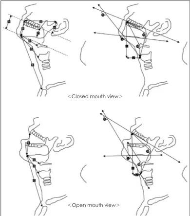 Fig. 1. Radiologic parameters on lateral extension neck X-ray with  closed and open mouth
