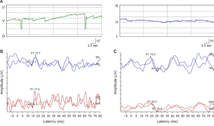 Fig. 1. Results of vestibular function test. (A) Video-nystagmographic recordings showed down-beating spontaneous nystagmus (2.7 degree/sec)
