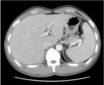 Figure 1. Multiple, enlarged, enhancing lymph nodes at  level II on both sides of the neck (arrows).